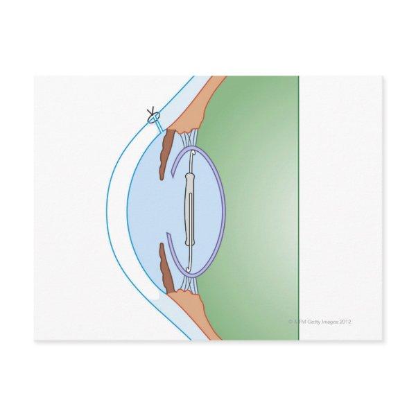 Cataract Surgery Postcard
