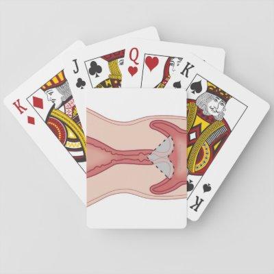 Cervical Conization Biopsy Playing Cards
