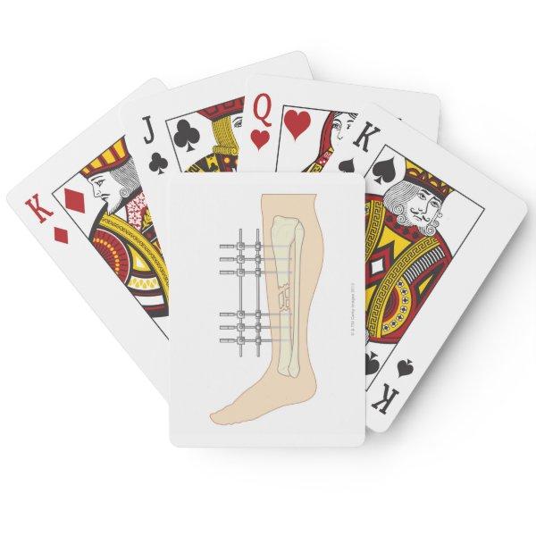External Fixator Poker Cards