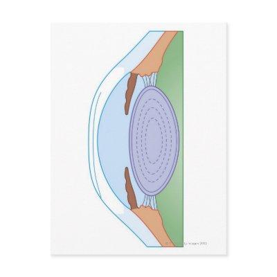 Eye After Corrective Surgery Postcard