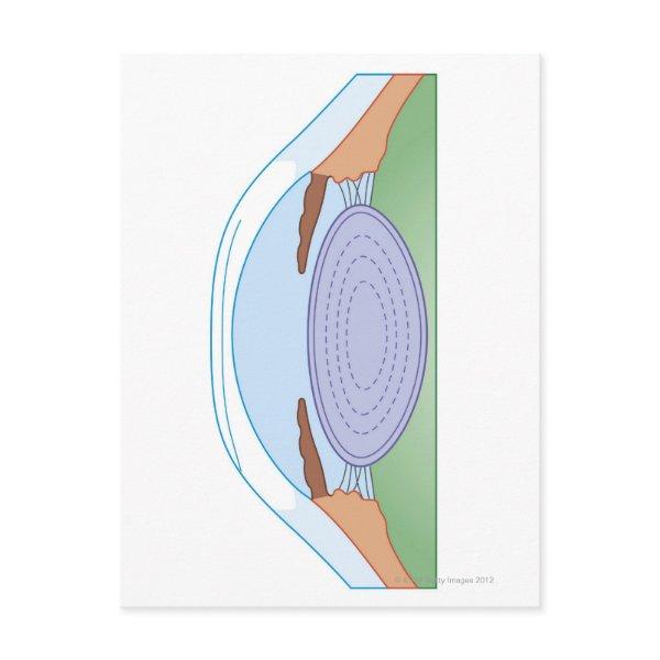 Eye After Corrective Surgery Postcard