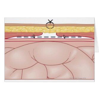 Illustration of a Hernia