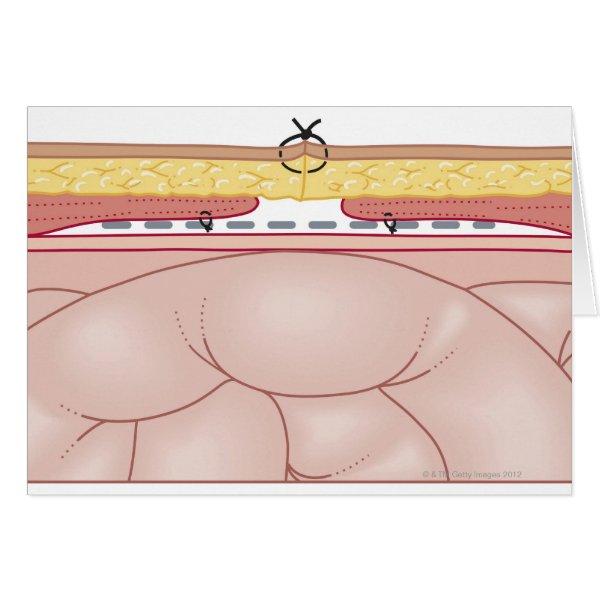 Illustration of a Hernia