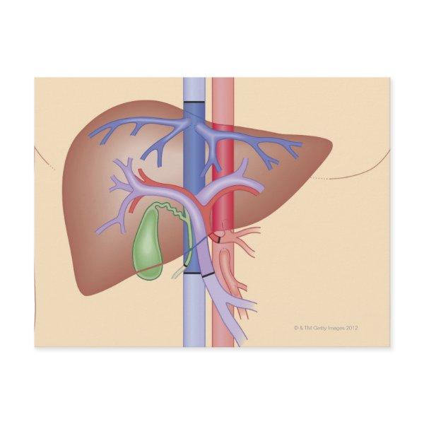 Liver Transplant Procedure Postcard