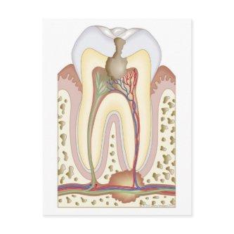 Pulp and Root Abscess Postcard