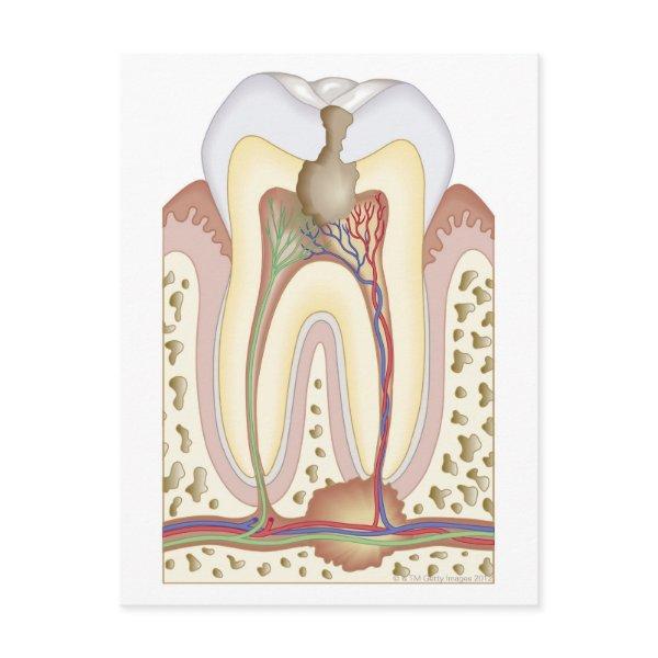 Pulp and Root Abscess Postcard